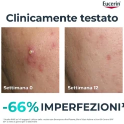 Eucerin Dermopure Siero Tripla Azione Oil Free per Acne 40 ml